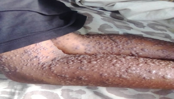 Pas de cas de variole du singe au Burundi 